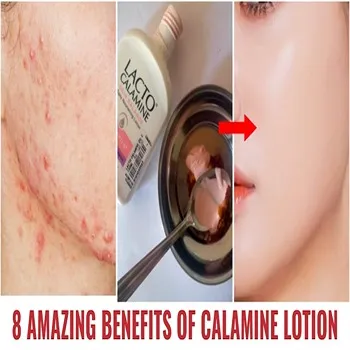 Calamin Lotion